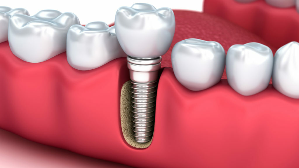 dentista-implantes-dentist-implants-sotogrande-pueblo-nuevo-guadiaro